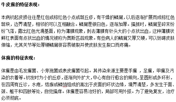 怎样通过临床表现来辨别牛皮癣和体癣