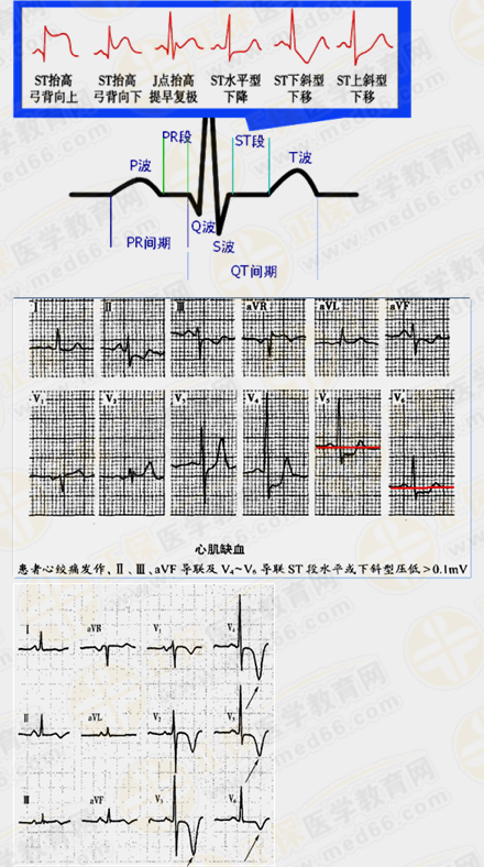 心肌缺血心电图特点