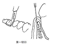 翻瓣术