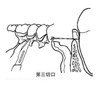 翻瓣术